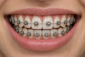 brackets autoligables