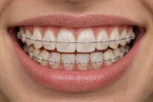 brackets de ceramica
