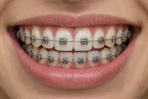tipos de brackets metalicos