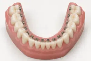 bracket lingual